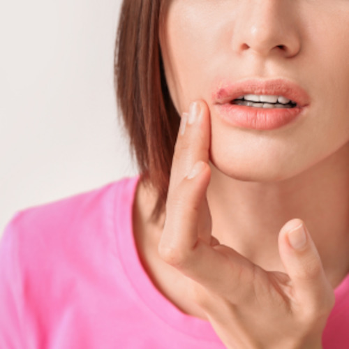 Early Care Service: Recurring cold sores consultation