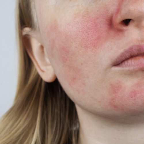 Early Care Service: Rosacea consultation