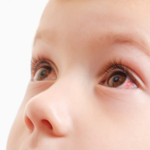 Conjunctivitis consultation (3 months to 2 years)