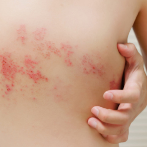 Early Care Service: Shingles consultation