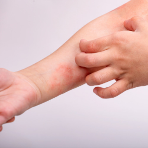 Early Care Service: Eczema management consultation