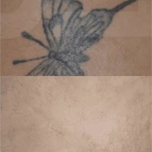 Products: Tattoo Removal