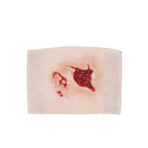 Open Wound