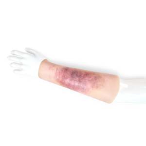 29 Sleeve Trauma: Bruise Sleeve