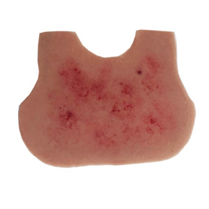 Meningitis Rash Infant Chest