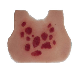 Anaphylactic Rash