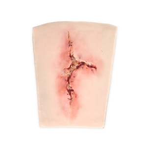 Large Infected Leg Wound