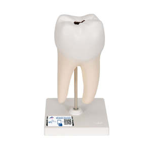 Lower Twin-Root Molar with Cavities Human Tooth Model, 2 Part (3B Scientific®)