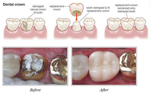 Products: Crowns