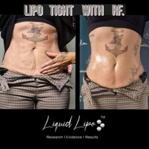 Products: Liquid Lipo Tight 5 day at-home kit Mystic Beauty