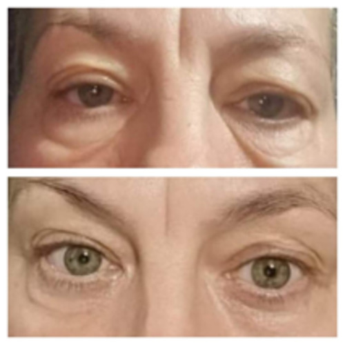 Blepharonat Peri Orbital Removal Mystic Beauty