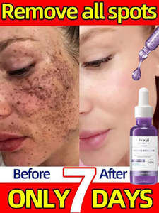 Health: Dark Spots Remover Whitening Serum Face Freckle Melanin Correcting Anti Pigmentation Brighten Beauty Korean Day Night Skin Care