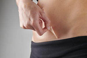 Products: The Original Caesarean silicone strips - 3 month supply Myscar