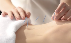Products: Acupuncture Services - Physio Movement