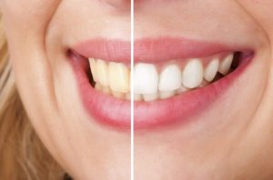 Wall posters (A1) 3 x choices bridal couple, mature couple or teeth with zerconi&hellip;