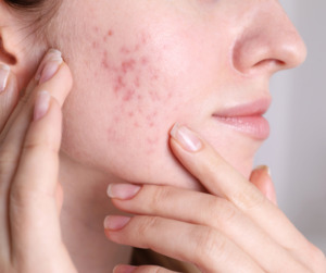 Skincare Product Range: Clearing Acne Balm 5ml Tube