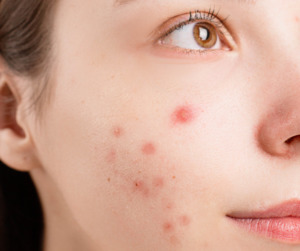 Skincare Product Range: Clearing Acne Balm 15ml Jar