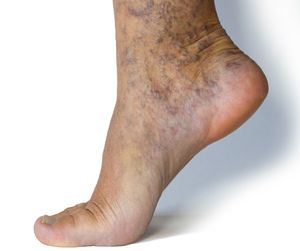 Magnesium: Varicose Vein Support Spray 100ml