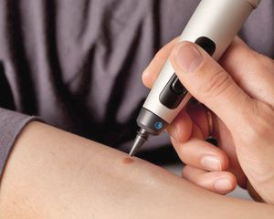 Products: Cryotherapy (CryoPen)