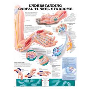 CHART UNDERSTANDING CARPAL TUNNEL SYNDROME