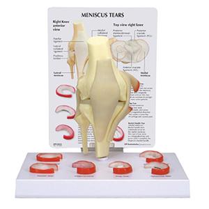 MENISCUS KNEE MODEL WITH 6 TEARS