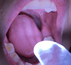 Throat Scope Holland HealthCare - Zabonne